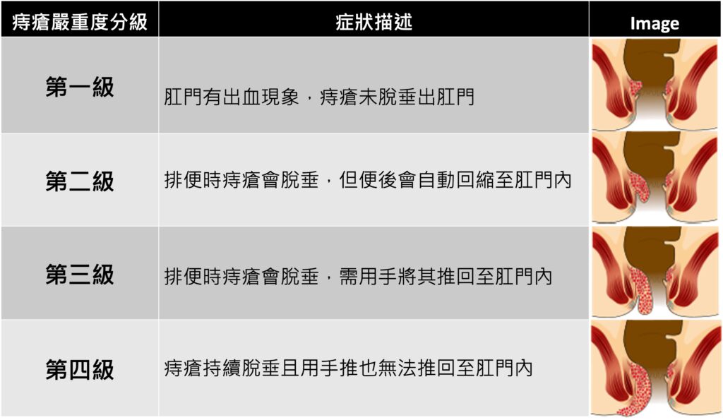 痔瘡反覆出血脫垂不用怕 最新微創雷射無限環技術邁入精準收縮無痛新紀元 48 %E5%9C%96%E7%89%87 1
